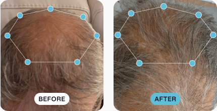 Simon’s hair before (left) and after (right) using MDhair