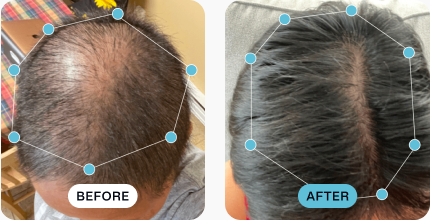 Tina’s hair before (left) and after (right) using MDhair