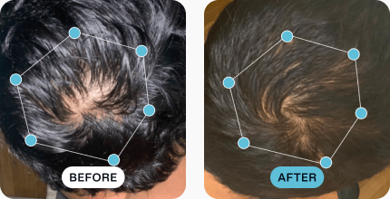 Vaibhav’s hair before (left) and after (right) using MDhair